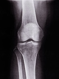 x-ray of a knee